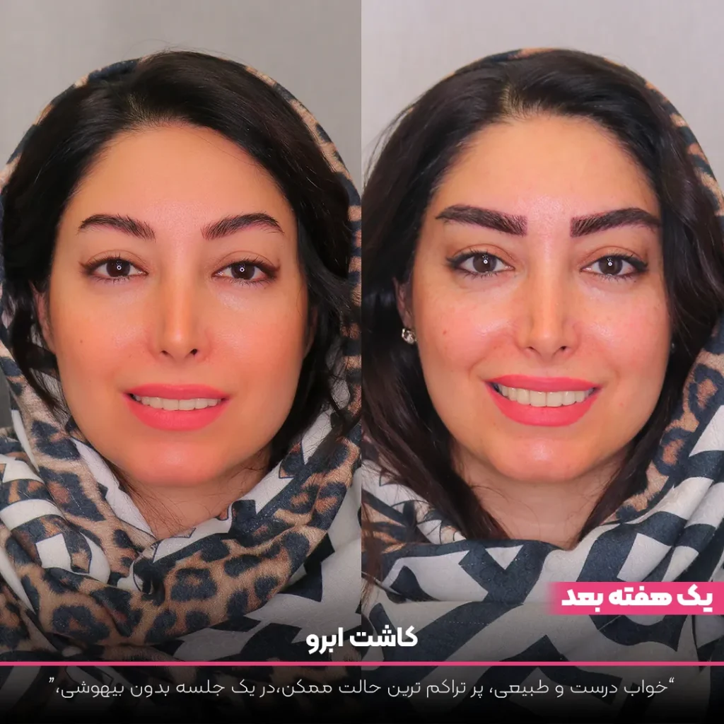عکس قبل و بعد کاشت ابرو