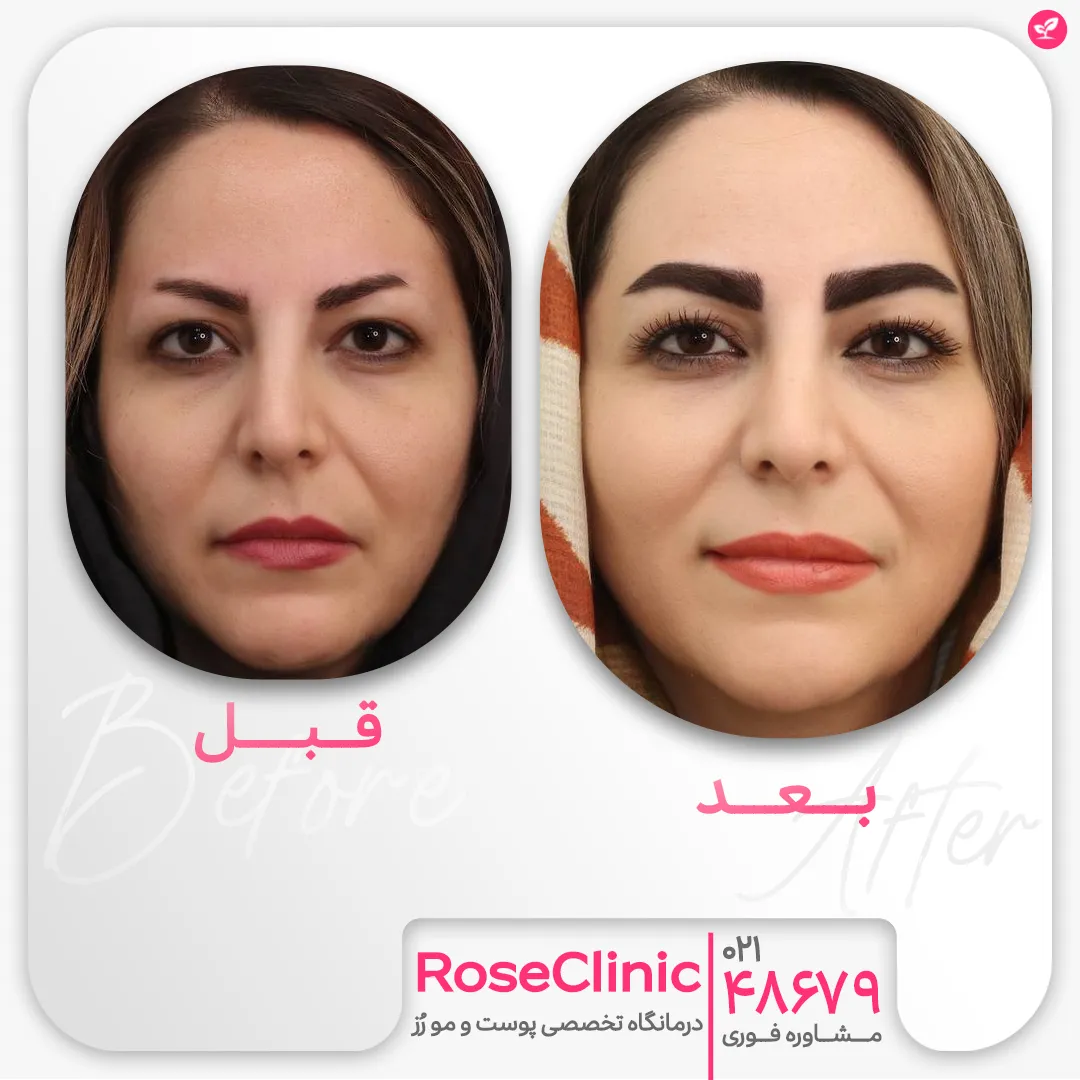 صورت خانم قبل و بعد از کاشت ابروی طبیعی