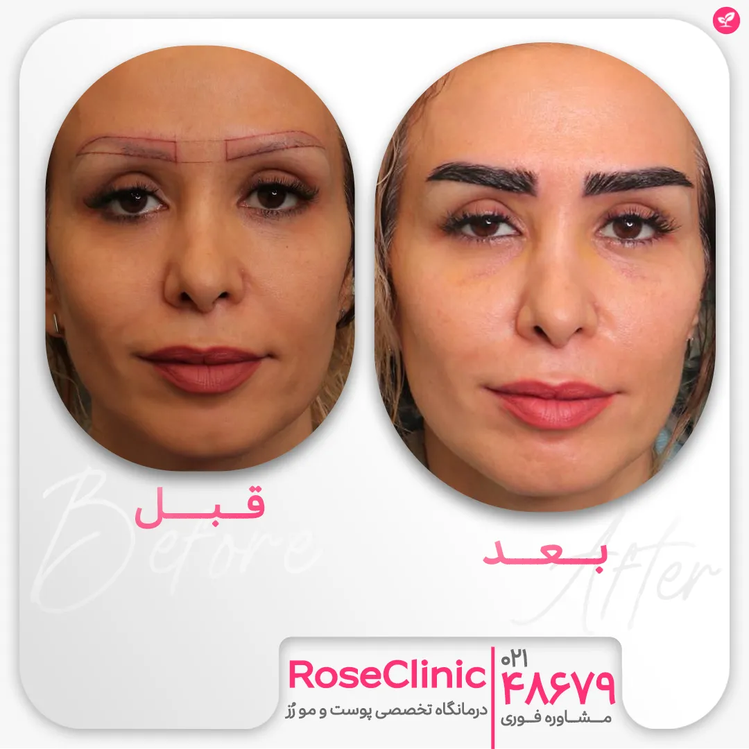 تغییر چهره خانم قبل و بعد از کاشت ابروی نچرال