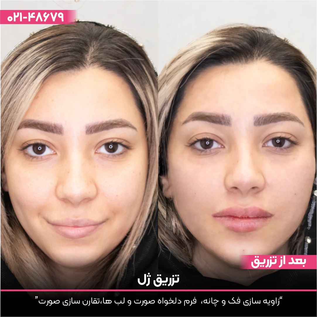 عکس قبل و بعد صورت دختری که تزریق ژل انجام داده است