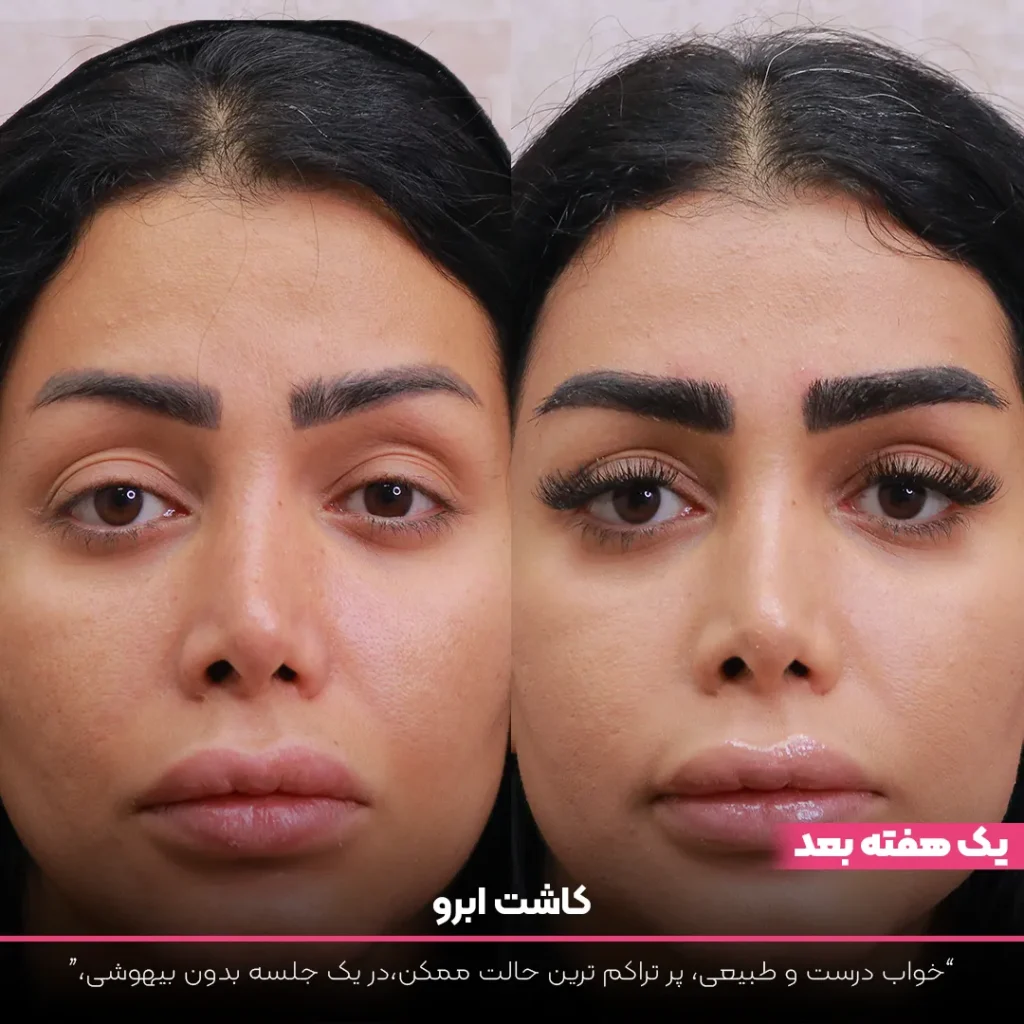 عکس قبل و بعد کاشت ابرو