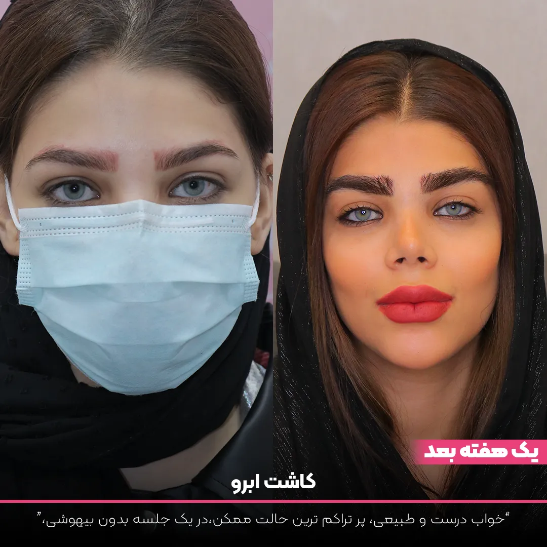 عکس قبل و بعد از چهره خانمی که کاشت ابرو انجام داده است - کاشت ابرو