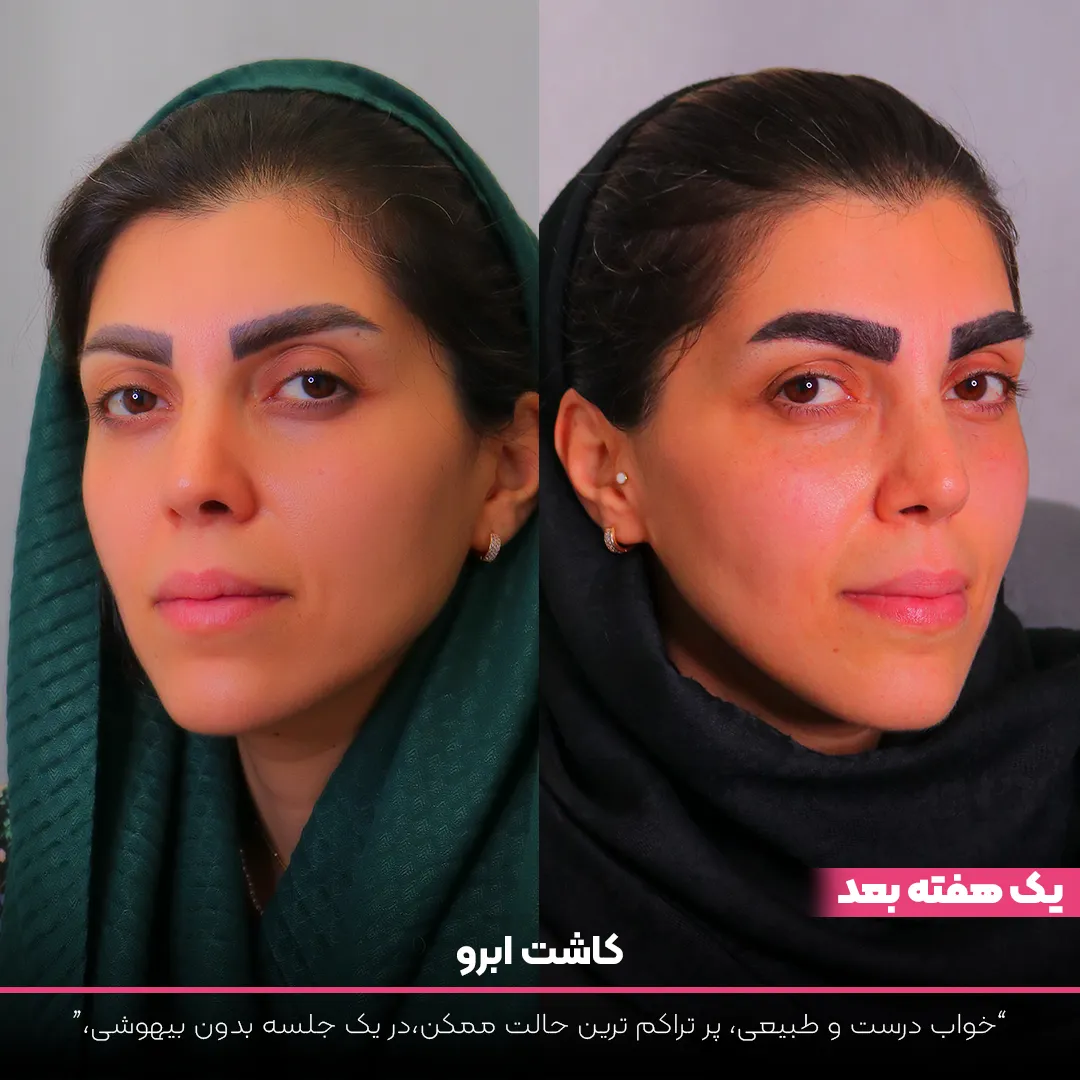 عکس قبل و بعد از صورت خانمی که در ابتدا ابروهای نازکی داشته و اما بعد از کاشت ابروهای پرپشتی دارد