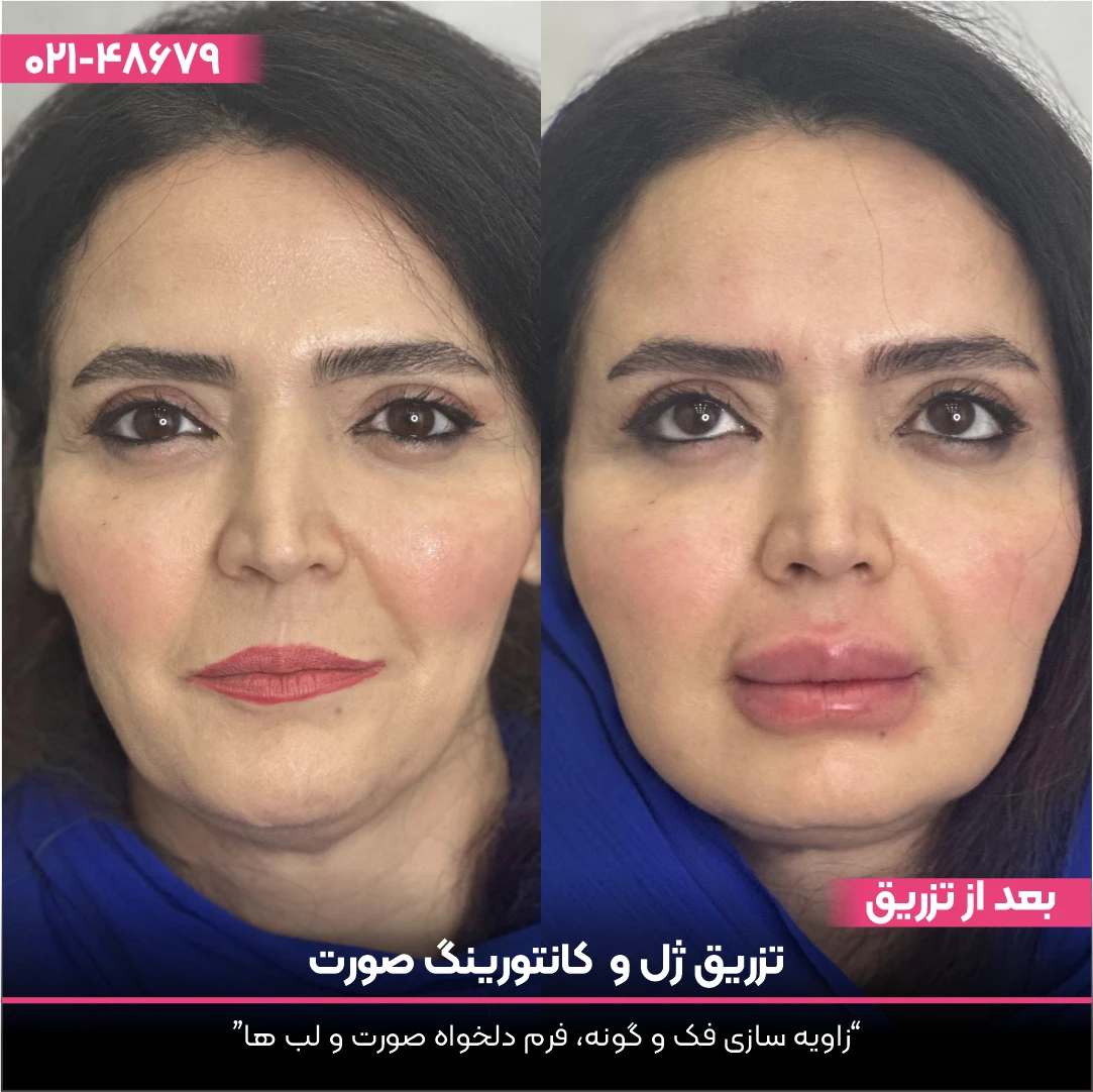 خانمی که به چند ناحیه از صورت مثل گونه ها و لب ها ژل تزریق کرده است