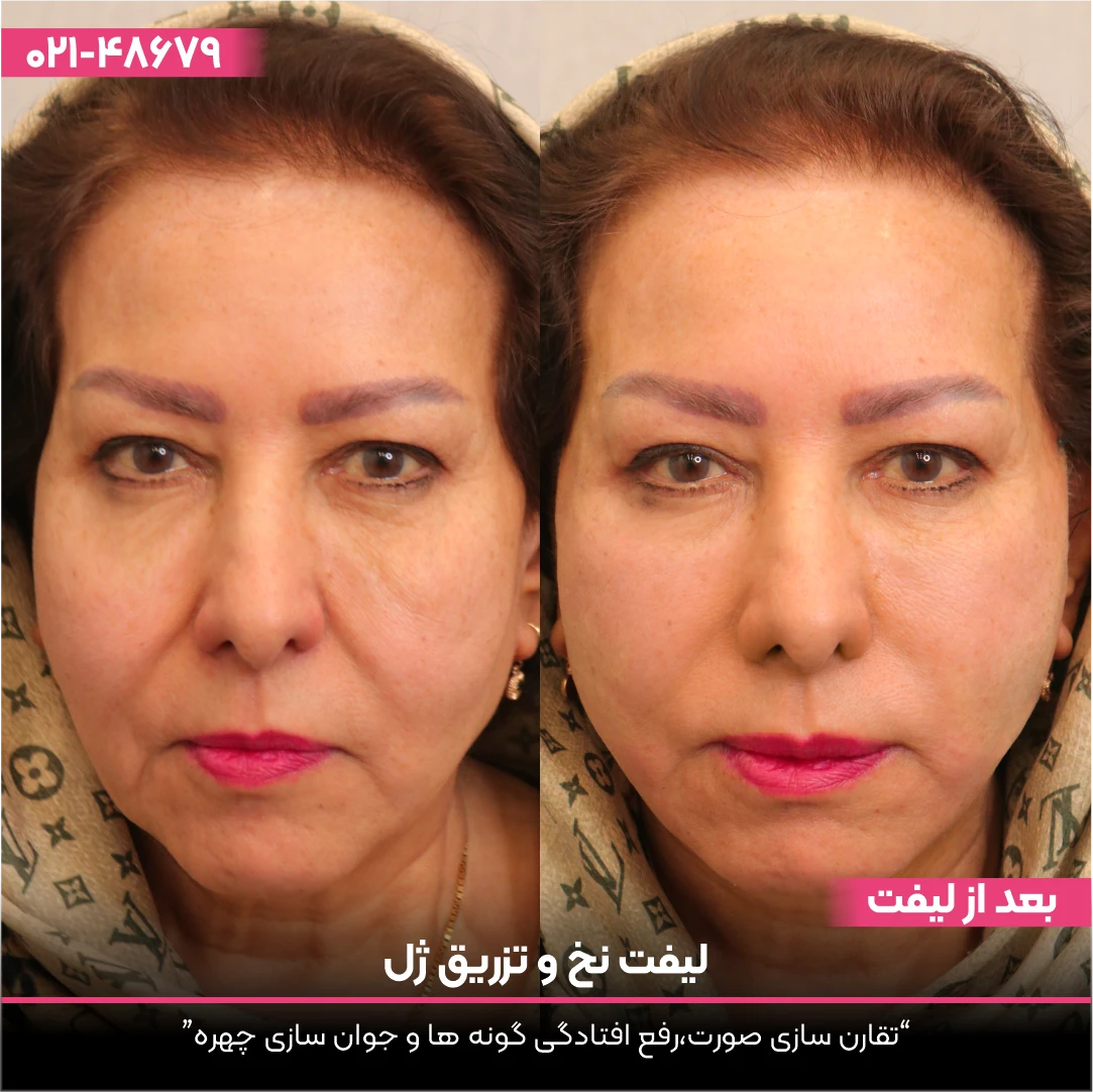 عکس قبل و بعد خانمی که با تزریق ژل جوان تر شده است