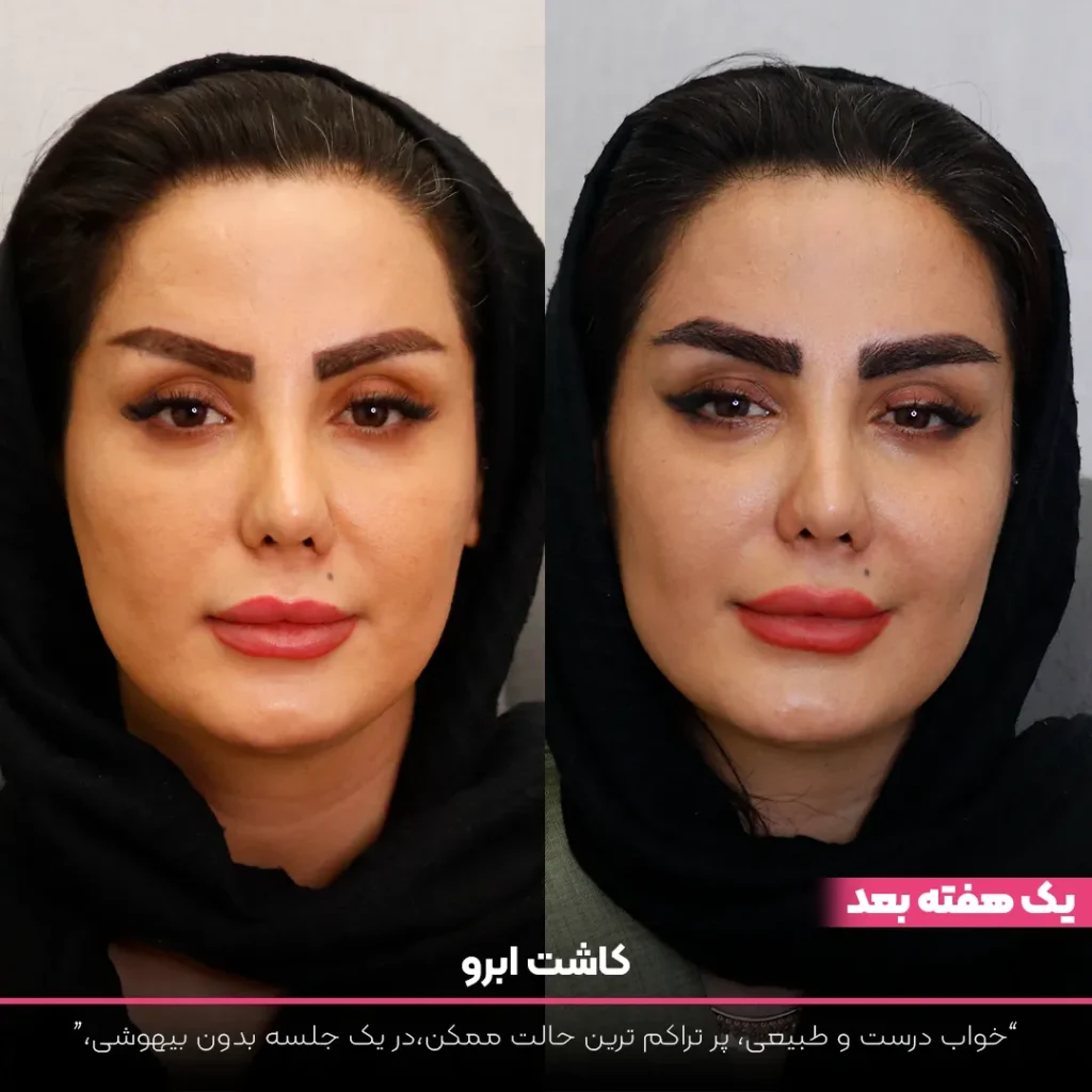 عکس قبل و بعد کاشت ابرو