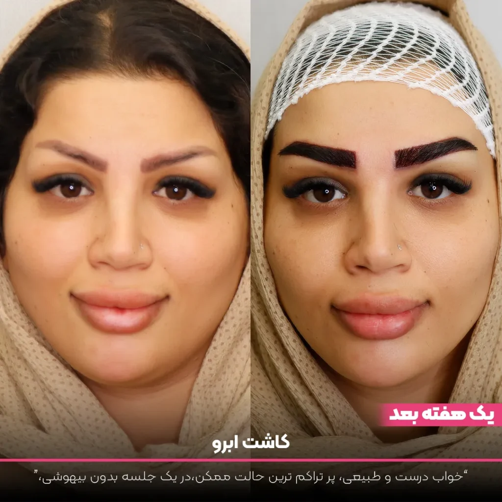 عکس قبل و بعد کاشت ابرو