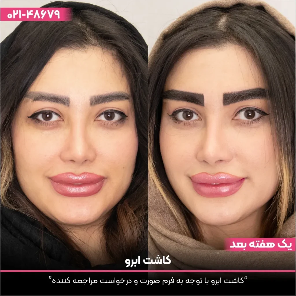 عکس قبل و بعد کاشت ابرو