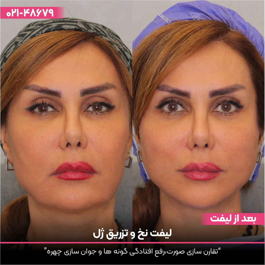 عکس قبل و بعد تزریق ژل به خام در کلینیک زیبایی رز