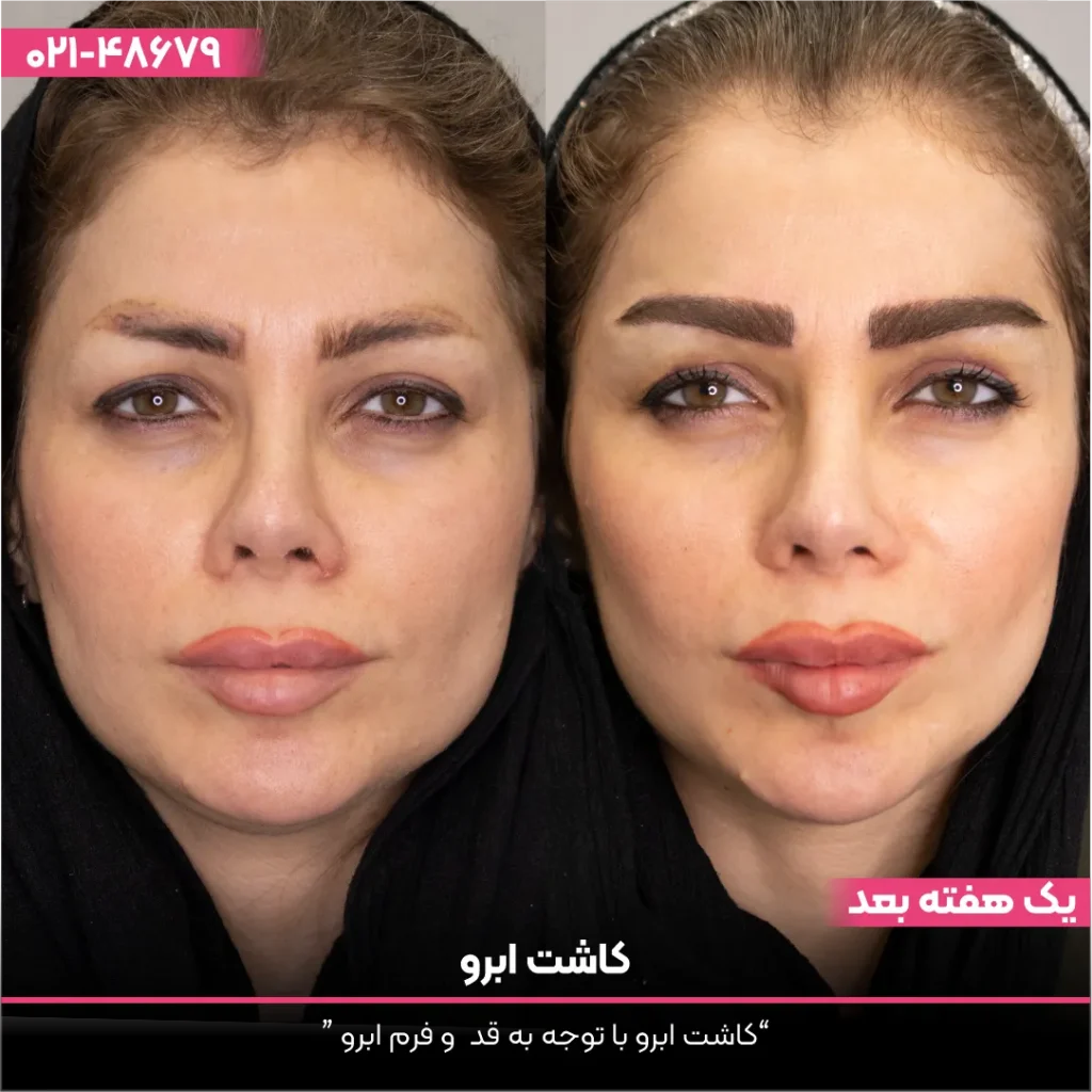 عکس قبل و بعد کاشت ابرو
