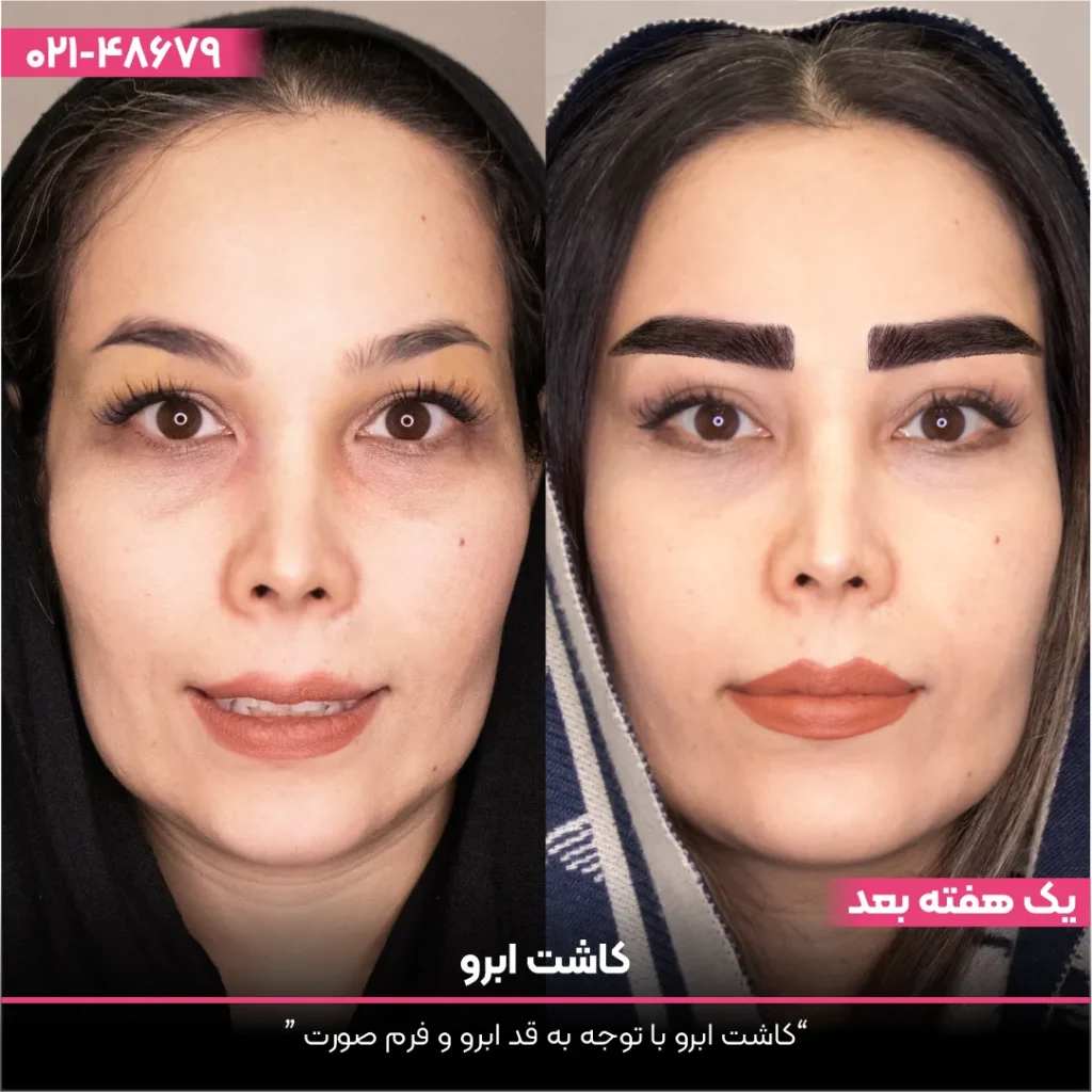 عکس قبل و بعد کاشت ابرو