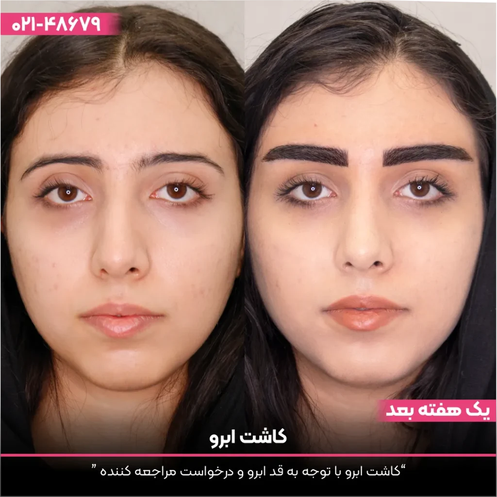 عکس قبل و بعد کاشت ابرو