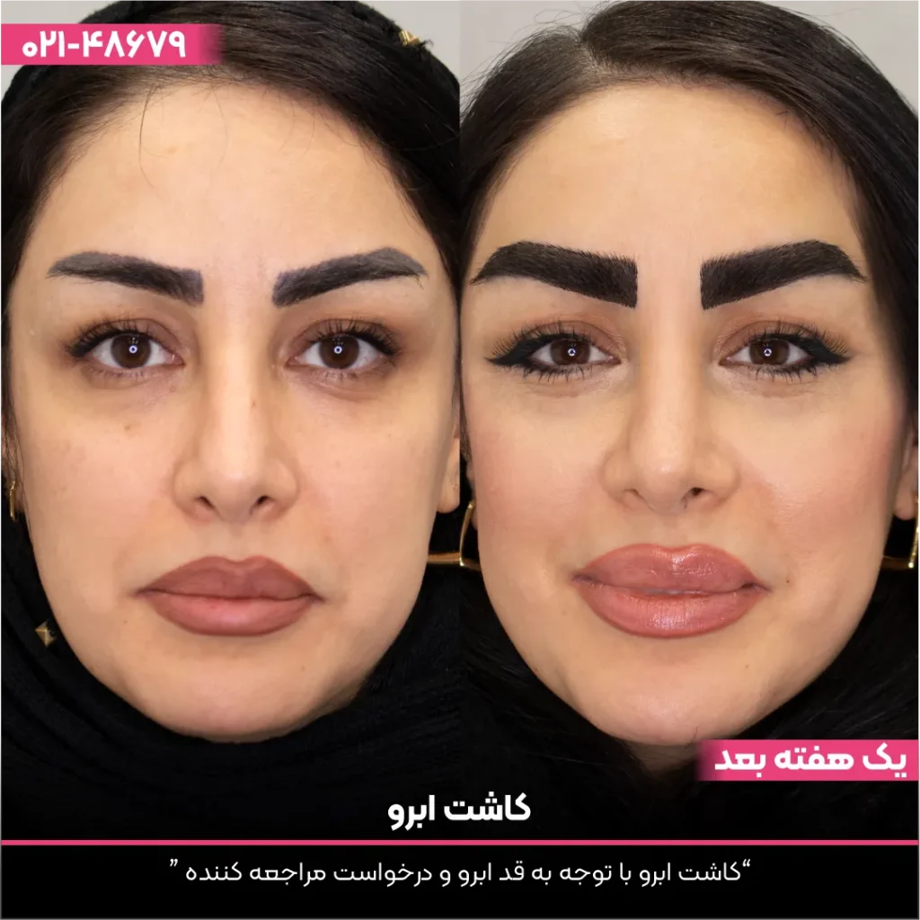 عکس قبل و بعد کاشت ابرو