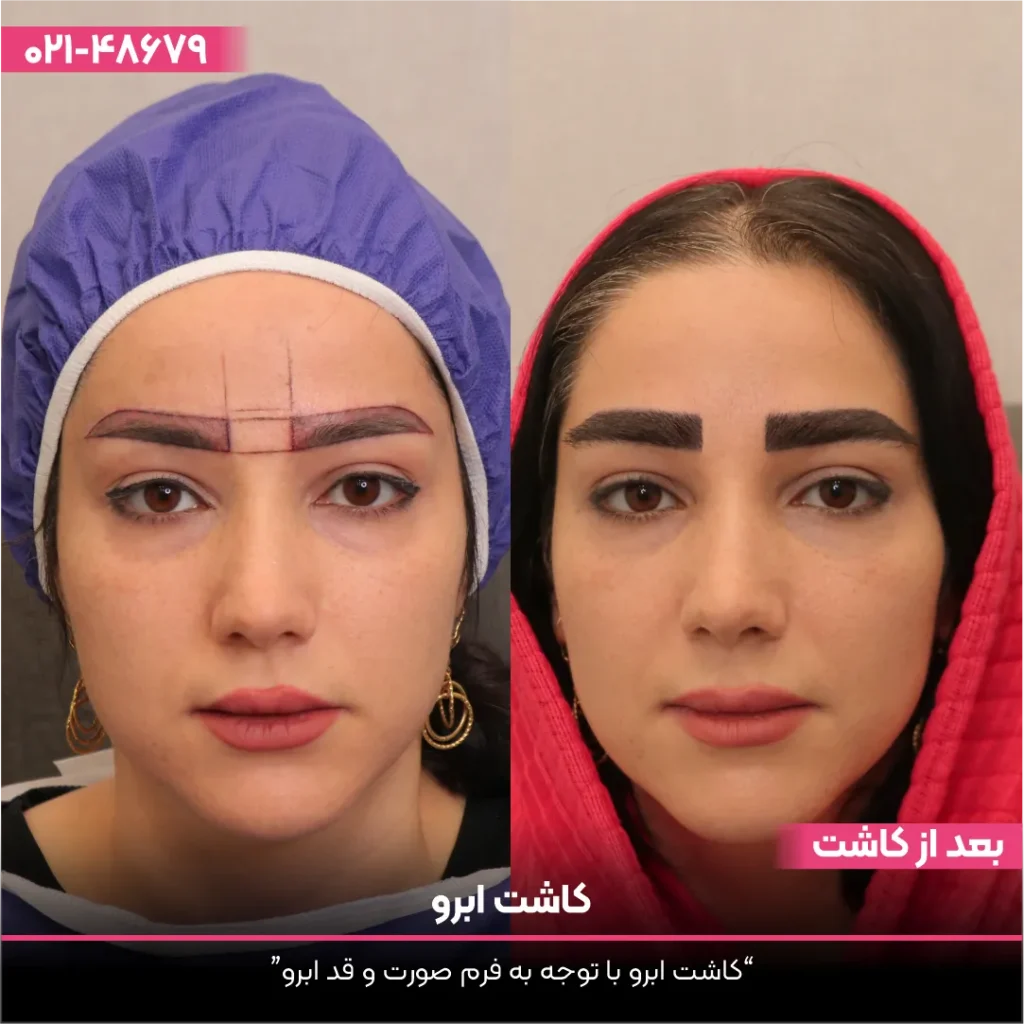عکس قبل و بعد کاشت ابرو