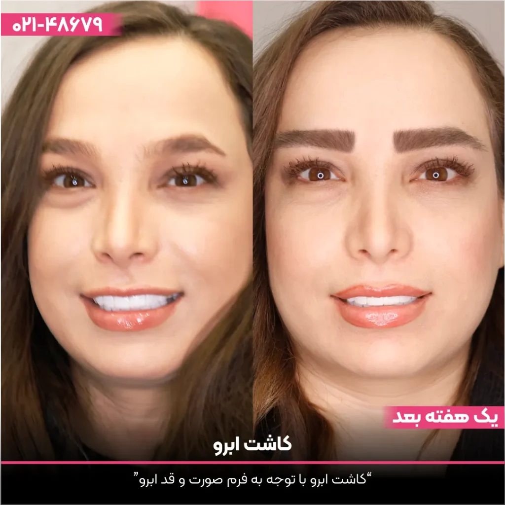 عکس قبل و بعد کاشت ابرو
