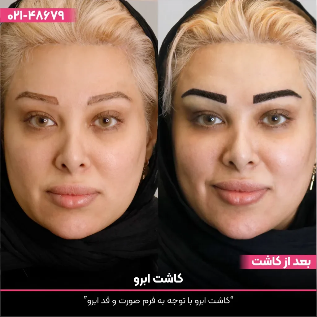 عکس قبل و بعد کاشت ابرو