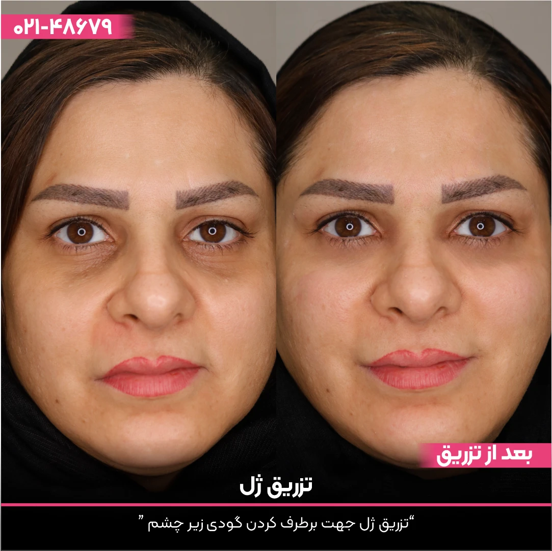 عکس قبل و بعد تزریق ژل به صورت خانم مراجعه کننده