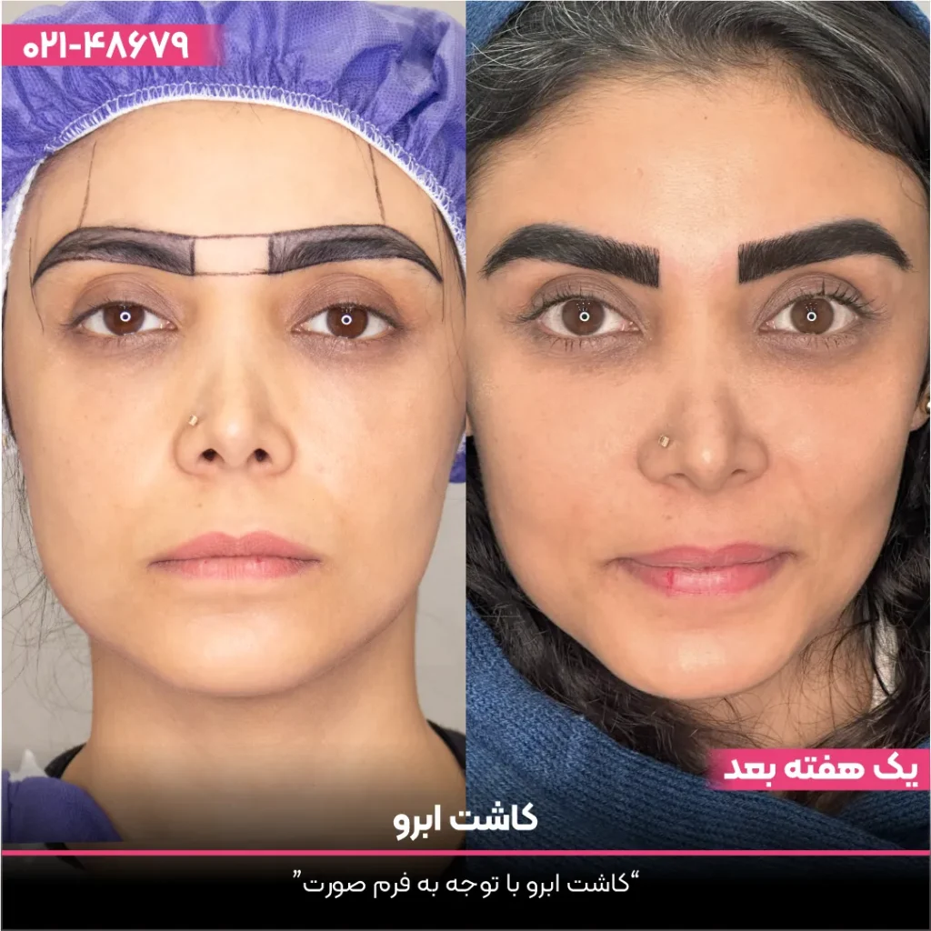 عکس قبل و بعد کاشت ابرو