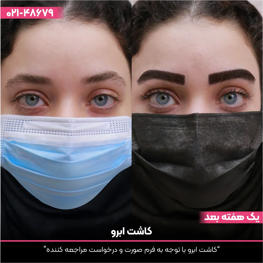 عکس قبل و بعد دختر جوانی که ماسک به صورت دارد و ابروهای خود را کاشت کرده
