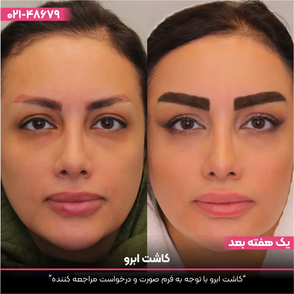 عکس قبل و بعد کاشت ابرو