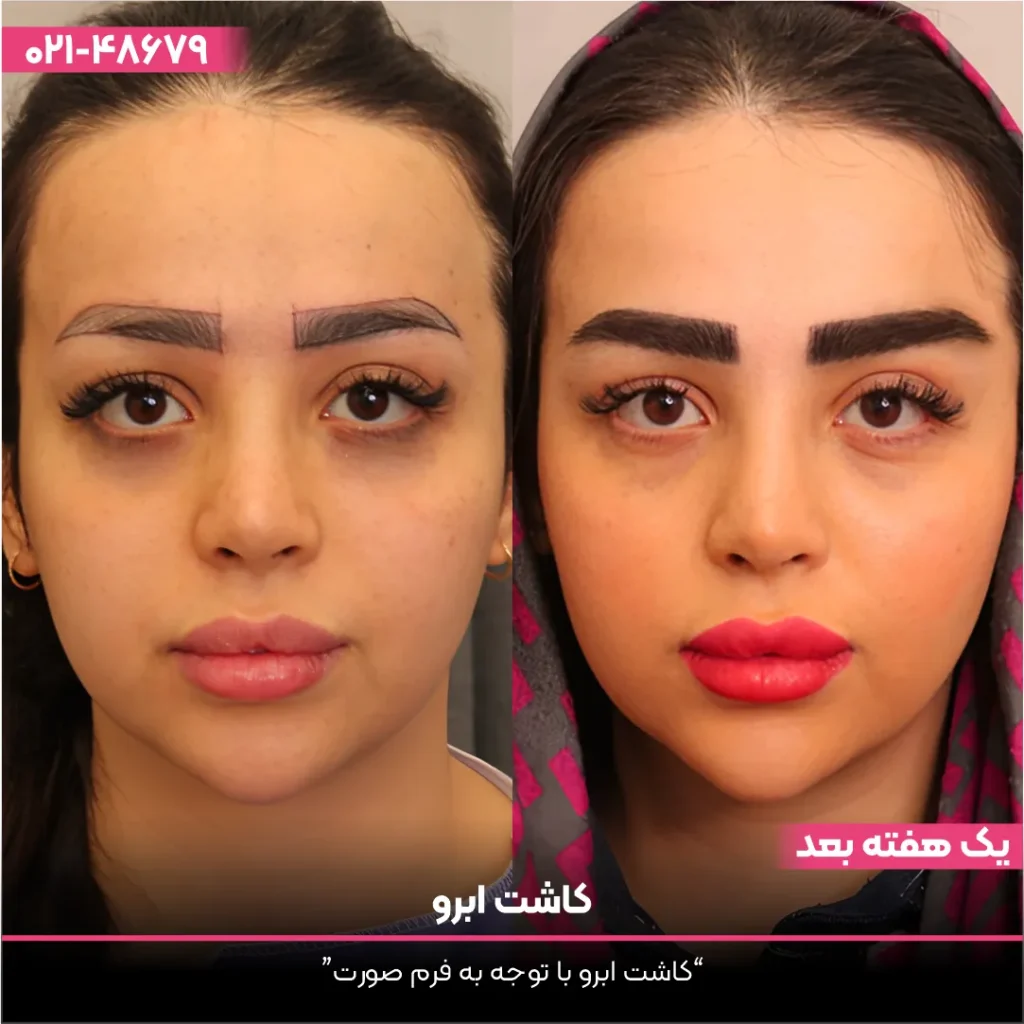 عکس قبل و بعد کاشت ابرو