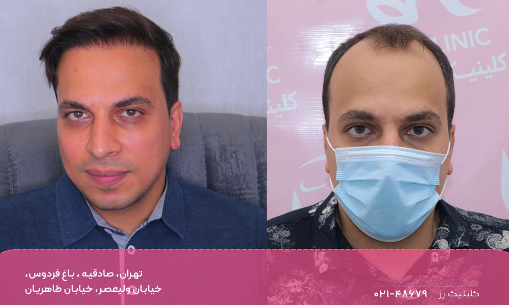 مقایسه قبل و بعد کاشت مو – تغییر خط رویش و افزایش تراکم موها