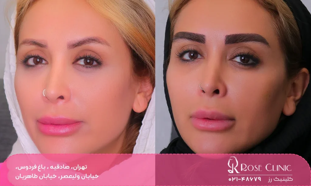 عکس قبل و بعد کاشت ابرو که باعث شده فرد ابروهای پرپشت و خوش فرم تری داشته باشد - کاشت ابرو