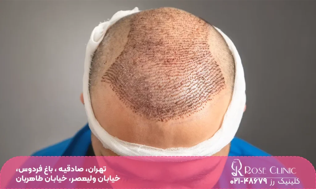 پیوند مو سر برای یک آقا