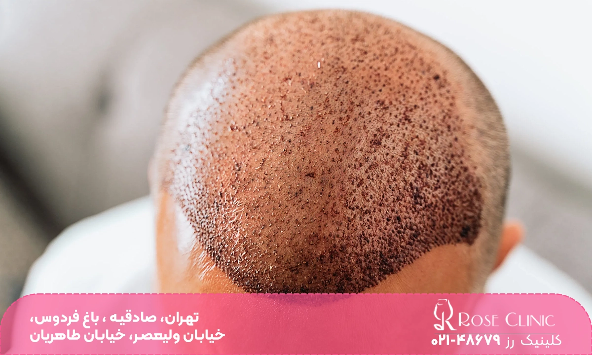 کاشت با پیوند مو سر برای یک آقا