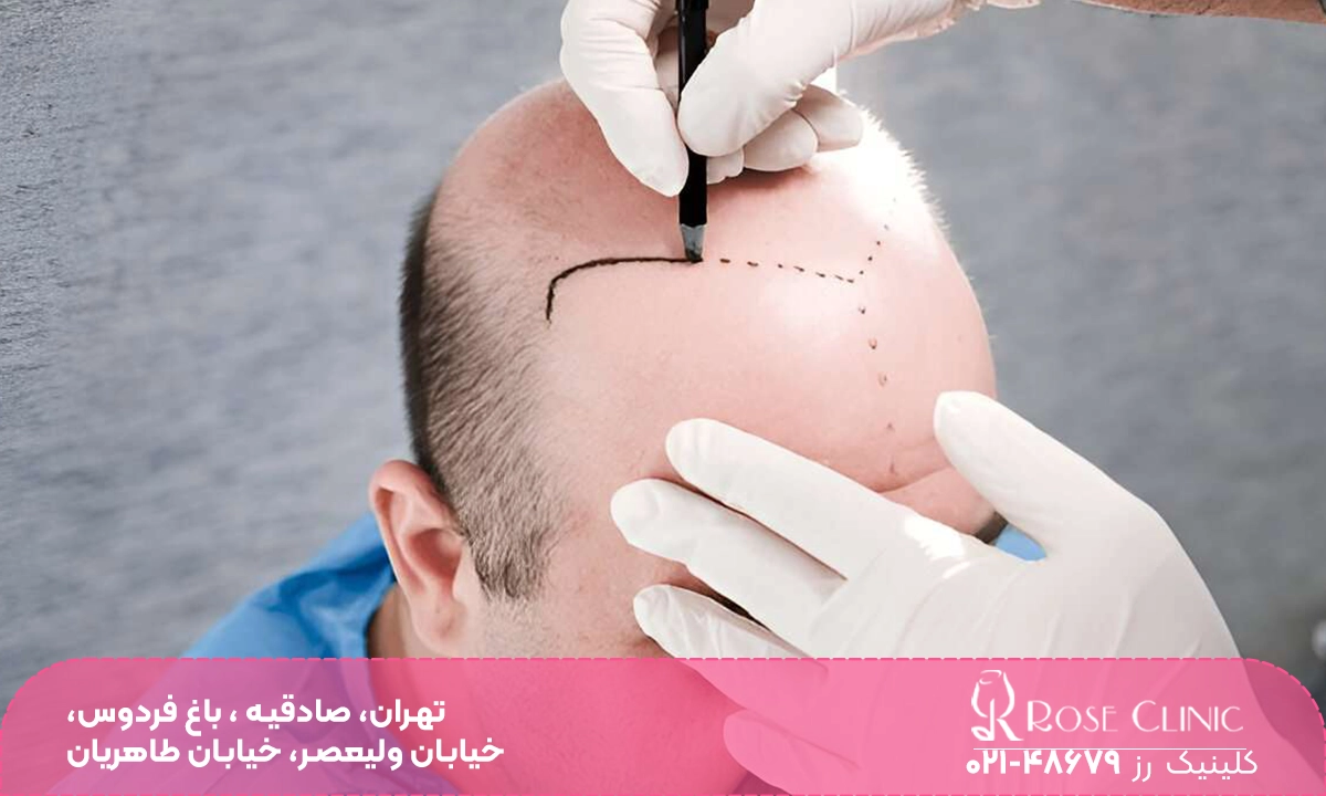 آماده کردن بیمار برای پیوند مو سر