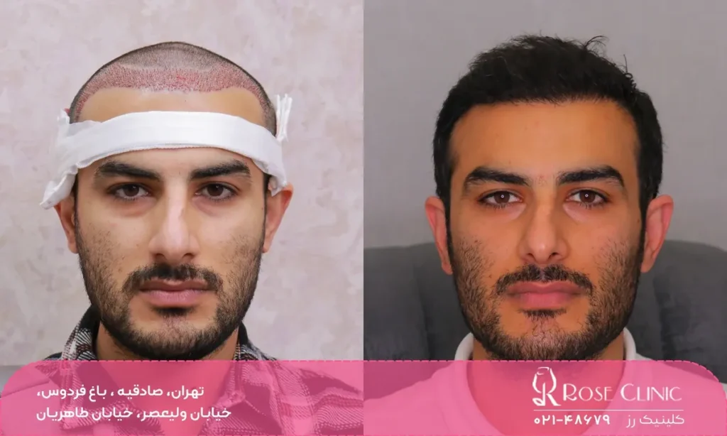 عکس قبل و بعد کاشت مو مراجعه کننده آقا در کلینیک زیبایی رز