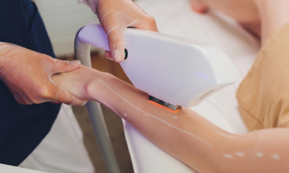 لیزر موهای زائد