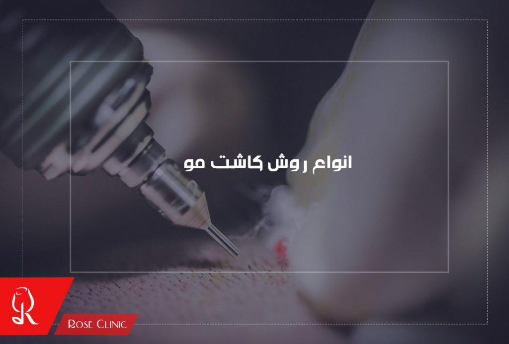 روش کاشت مو