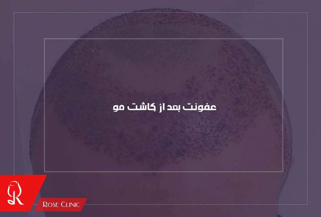 عفونت در حین کاشت مو