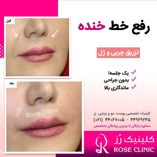 عکس تزریق ژل