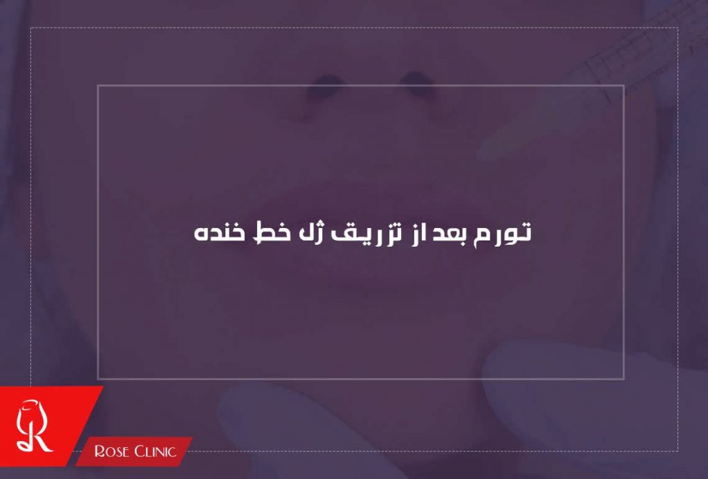 تورم بعد از تزریق ژل خط خنده