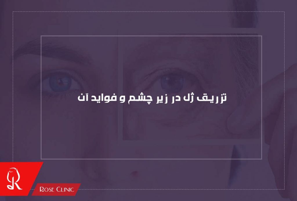 تزریق ژل در زیر چشم