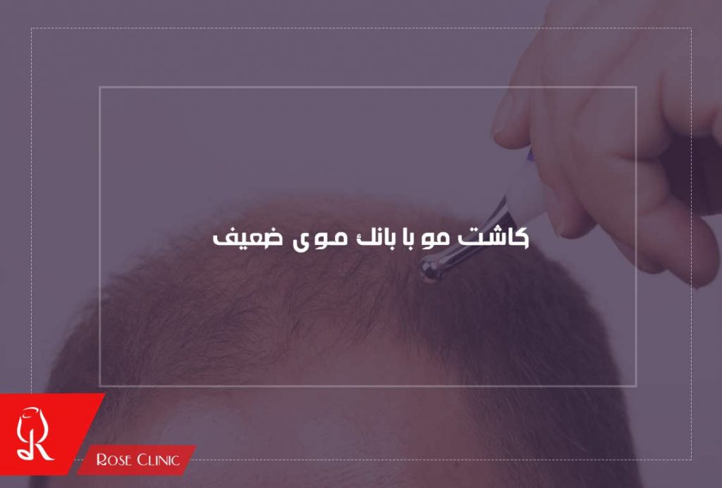 کاشت مو با بانک موی ضعیف