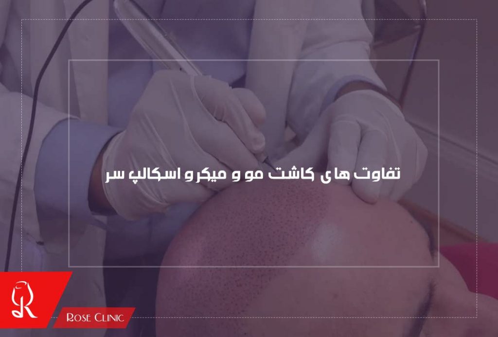 تفاوت های کاشت مو و میکرو اسکالپ سر