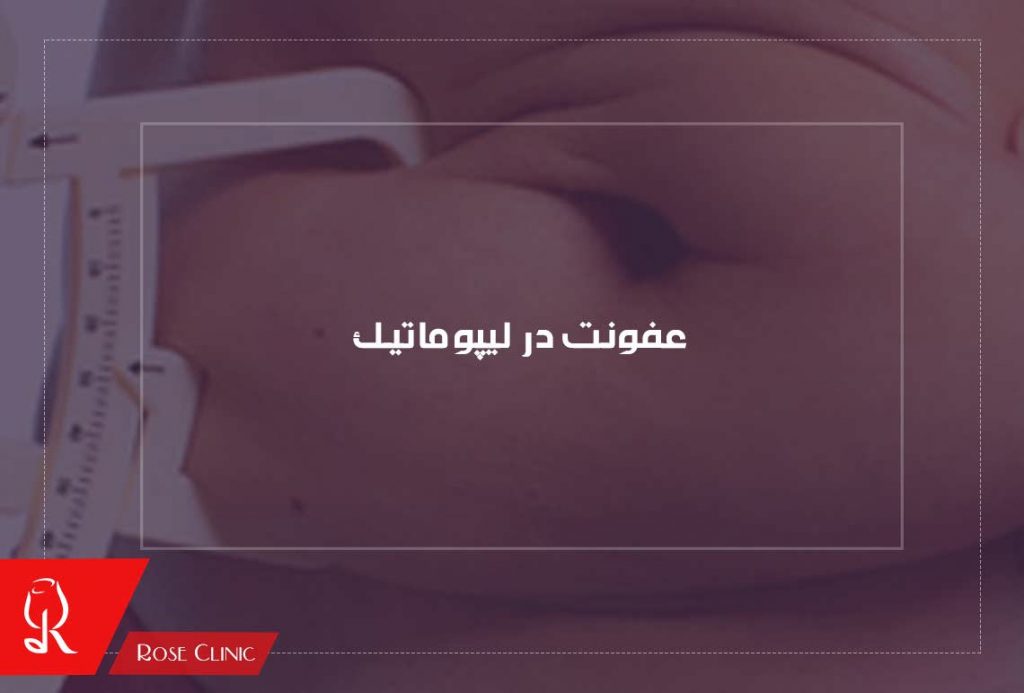 عفونت در لیپوماتیک