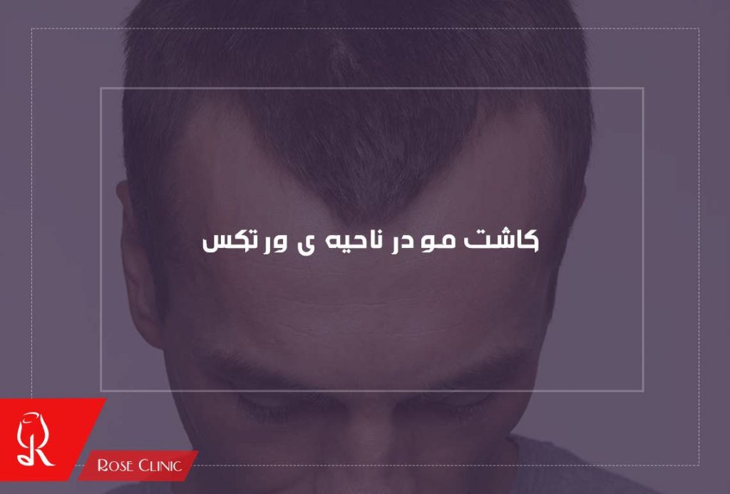 کاشت مو در ناحیه ی ورتکس