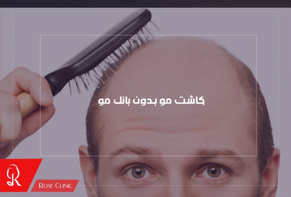 کاشت مو بدون بانک مو