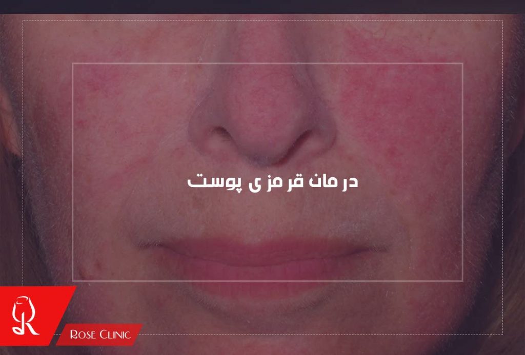 درمان قرمزی پوست