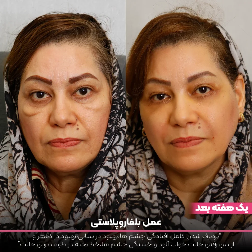 عکس قبل و بعد خانم مسن که بلفاروپلاستی انجام داده است
