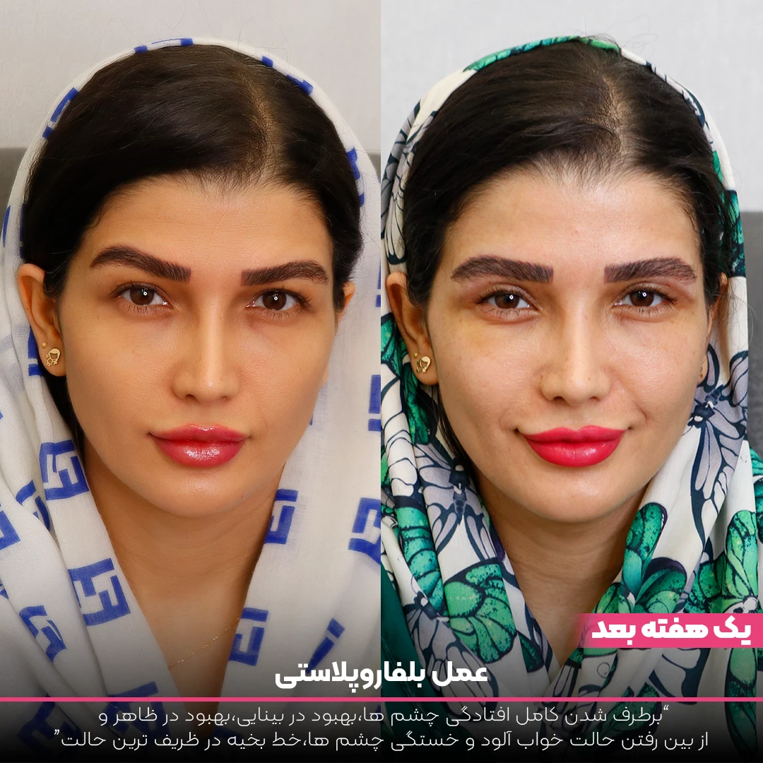 عکس قبل و بعد بلفاروپلاستی زیر چشم دختر