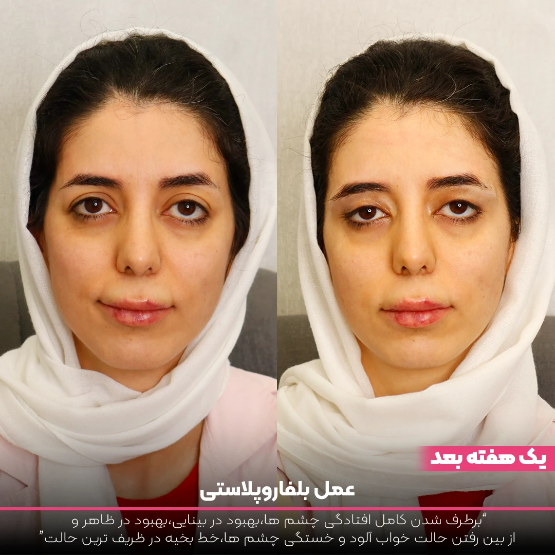 عکس قبل و بعد بلفاروپلاستی زیر چشم دختر
