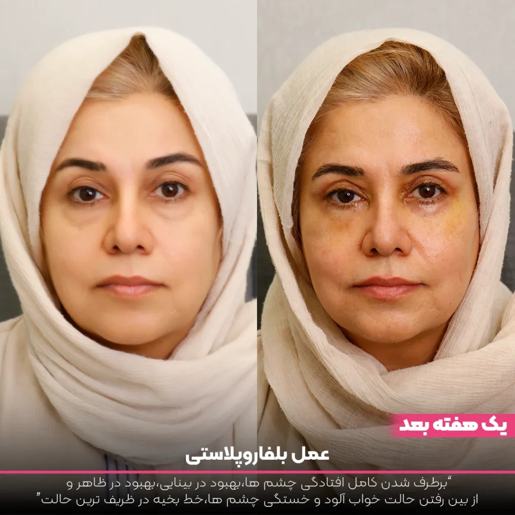 عکس قبل و بعد بلفاروپلاستی خانمی که شال کرم دارد