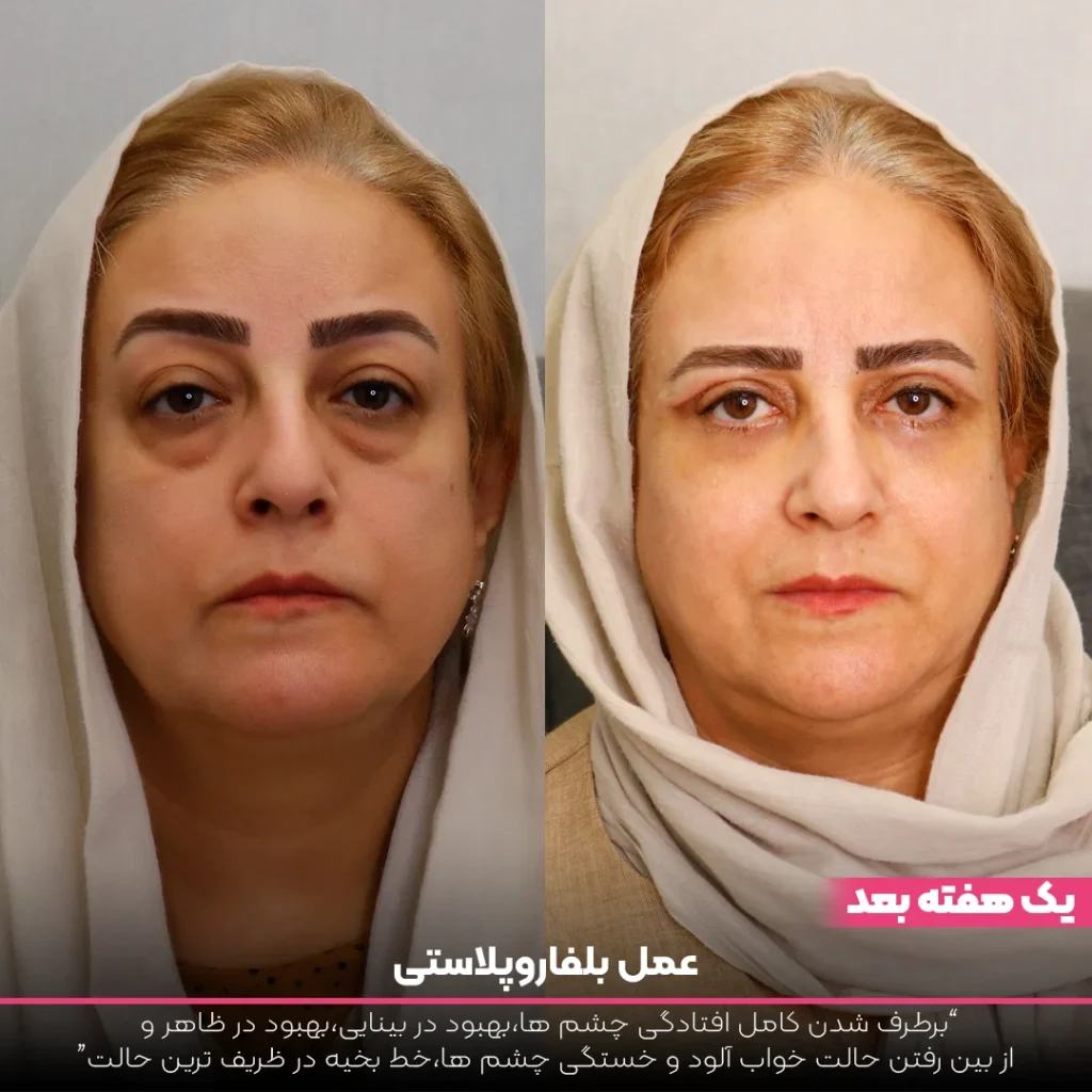 عکس قبل و بعد بلفاروپلاستی زن