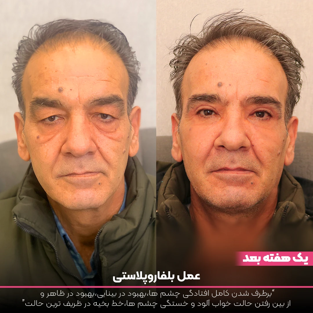 عکس قبل و بعد بلفاروپلاستی آقا