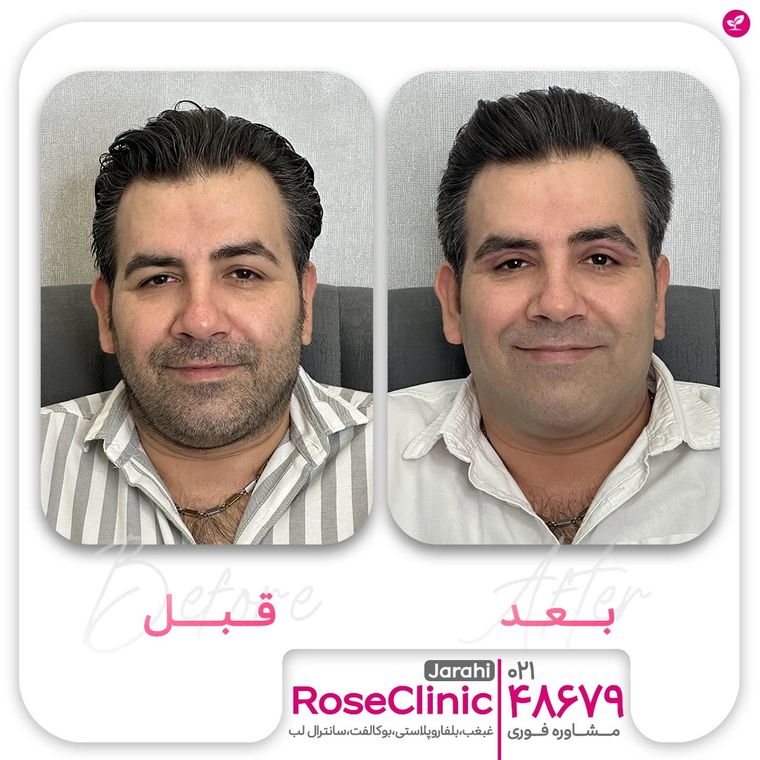 قبل و بعد بلفارو مرد